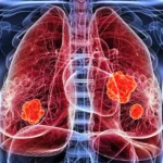 Early Signs of Lung Cancer: Warning Symptoms You Should Not Ignore