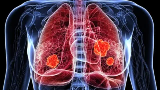 Early Signs of Lung Cancer: Warning Symptoms You Should Not Ignore