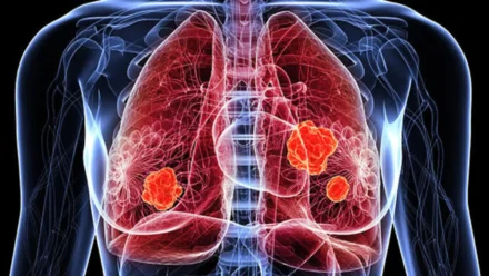 Early Signs of Lung Cancer: Warning Symptoms You Should Not Ignore