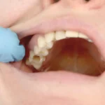 Hole in Tooth Pain Home Remedy: Temporary Relief for Cavity Toothache