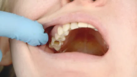 Hole in Tooth Pain Home Remedy: Temporary Relief for Cavity Toothache