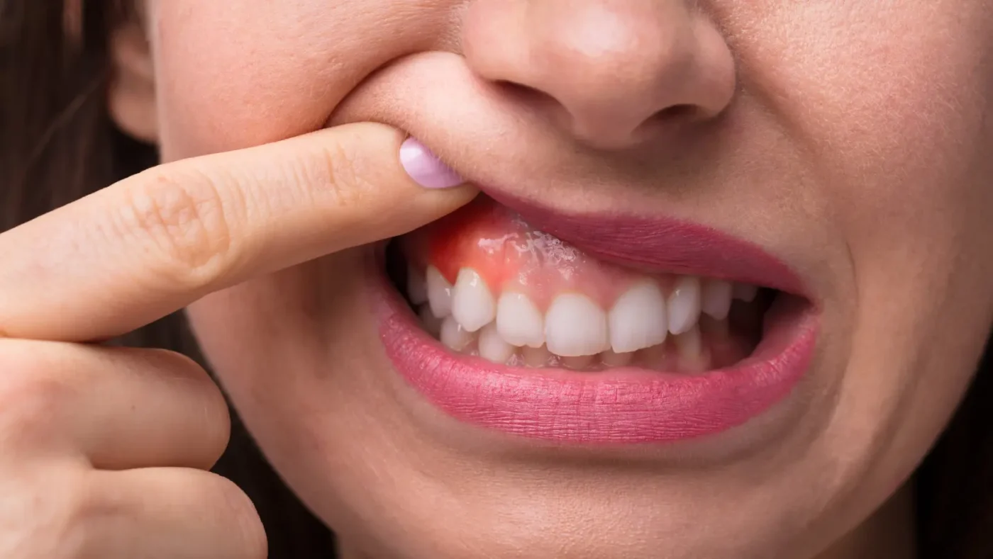 Swollen Gums Home Remedies: Natural Ways to Relieve Gum Swelling and Irritation