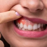 Swollen Gums Home Remedies: Natural Ways to Relieve Gum Swelling and Irritation