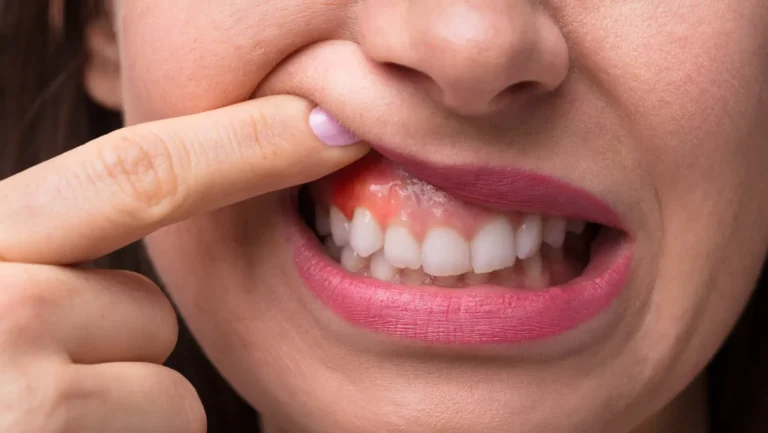 Swollen Gums Home Remedies: Natural Ways to Relieve Gum Swelling and Irritation