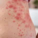 Home Remedies for Rashes: Natural Ways to Relieve Itching, Redness, and Skin Irritation
