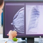 Signs of Breast Cancer in Women: Early Warning Symptoms You Should Never Ignore