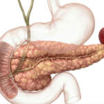 Can You Live Without Pancreas? What to Expect After Pancreas Removal