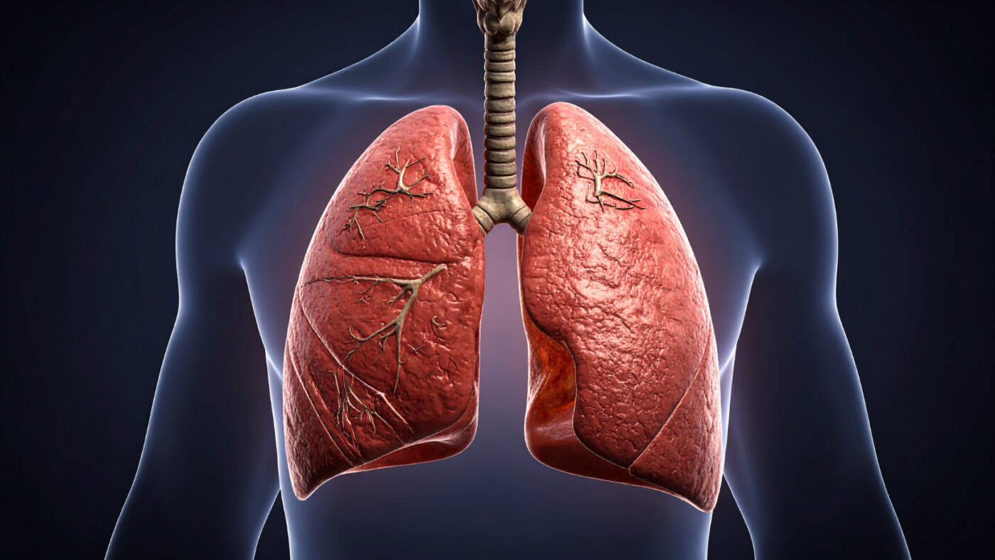 Can You Live With One Lung? Understanding Life After Lung Removal