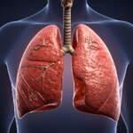 Can You Live With One Lung? Understanding Life After Lung Removal