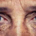 Signs of High Cholesterol on Face: Facial Clues That May Indicate Elevated Cholesterol Levels