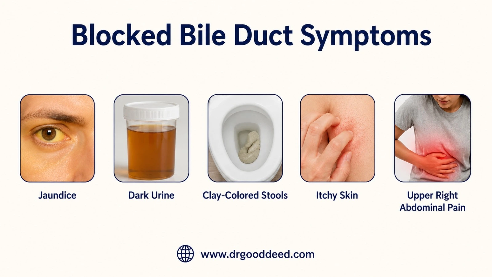 Blocked Bile Duct Symptoms