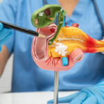 Bile Duct Obstruction: Causes, Symptoms, and Treatment Options