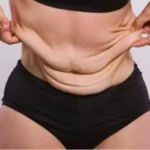 How to Tighten Loose Skin After Weight Loss: What Really Works?