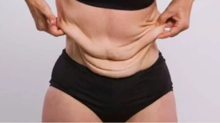 How to Tighten Loose Skin After Weight Loss: What Really Works?