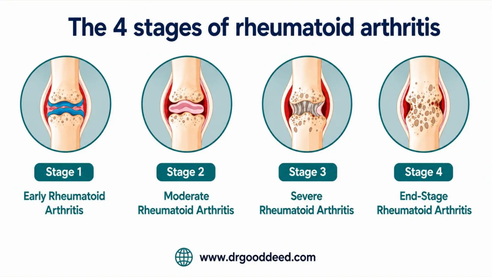 The 4 stages of rheumatoid arthritis