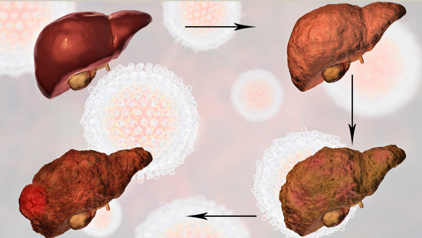Stages of Liver Fibrosis: Understanding Liver Scarring and Disease Progression