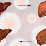Stages of Liver Fibrosis: Understanding Liver Scarring and Disease Progression