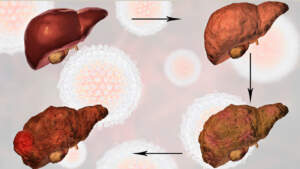 Stages of Liver Fibrosis