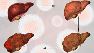 Stages of Liver Fibrosis: Understanding Liver Scarring and Disease Progression