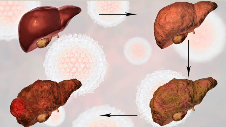 Stages of Liver Fibrosis: Understanding Liver Scarring and Disease Progression