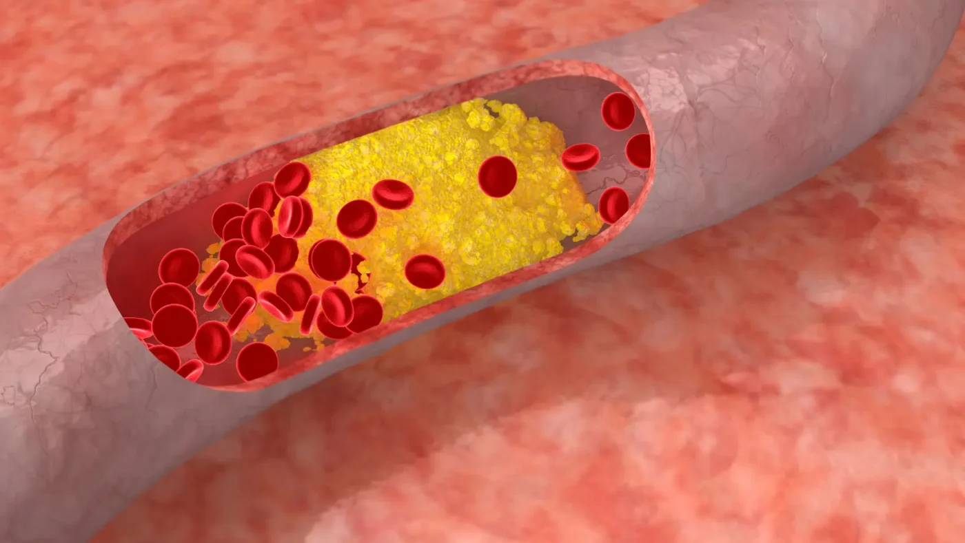 Warning Signs of High Cholesterol: Symptoms, Risks, and What You Need to Know