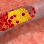 Warning Signs of High Cholesterol: Symptoms, Risks, and What You Need to Know