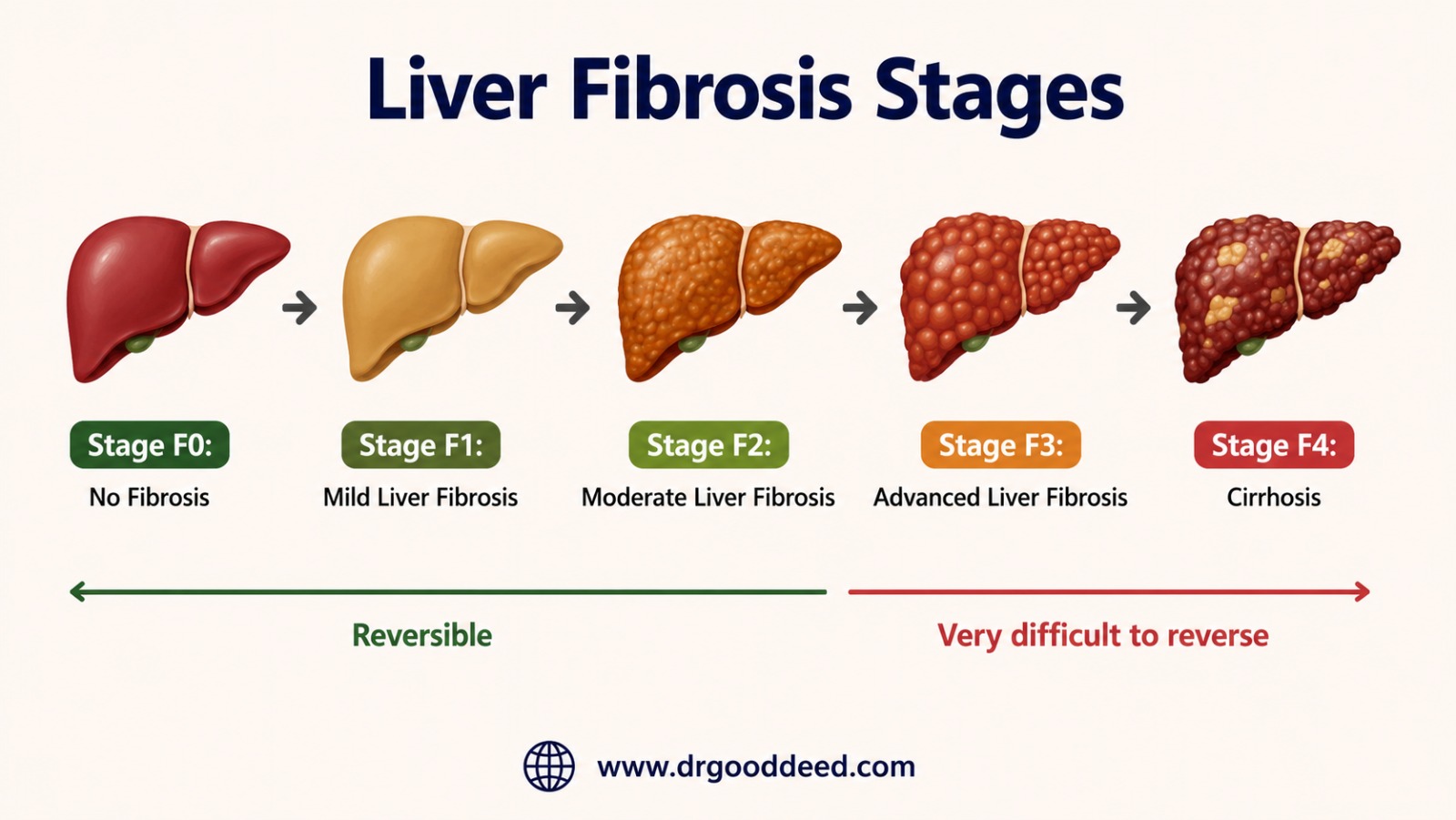 Liver Fibrosis Stages