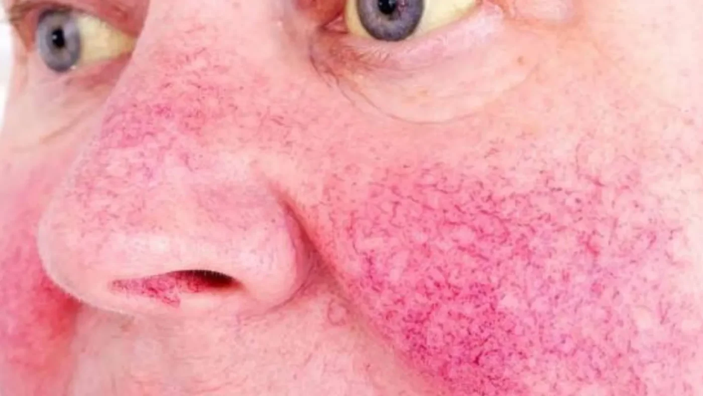 Fatty Liver Symptoms on Face: Are Facial Changes a Sign of Liver Disease?