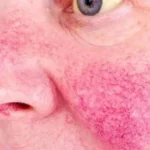 Fatty Liver Symptoms on Face: Are Facial Changes a Sign of Liver Disease?