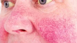 Fatty Liver Symptoms on Face: Are Facial Changes a Sign of Liver Disease?