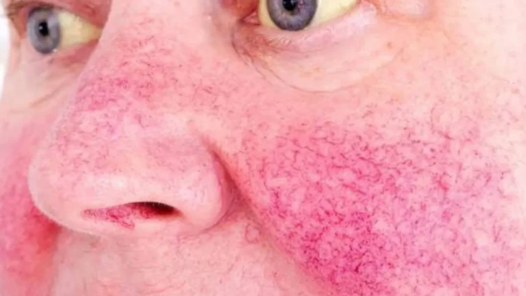 fatty liver symptoms on face​