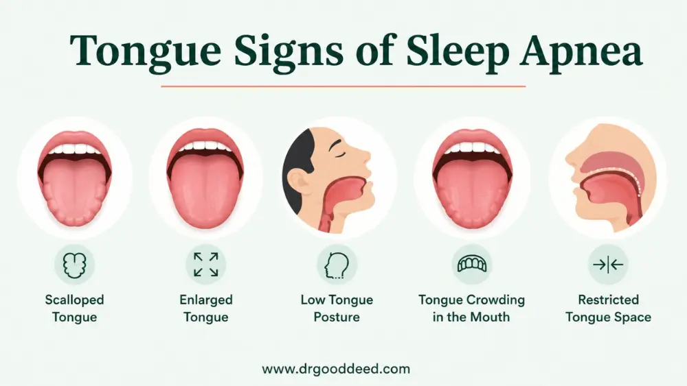 Tongue Signs of Sleep Apnea
