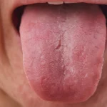 Tongue Signs of Sleep Apnea: How Tongue Shape and Position May Affect Breathing During Sleep