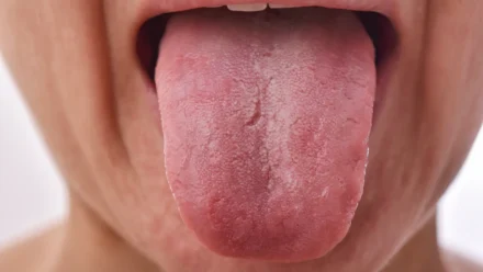 Tongue Signs of Sleep Apnea: How Tongue Shape and Position May Affect Breathing During Sleep