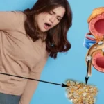 Home Remedies for Kidney Stones: 10 Natural Ways to Support Relief