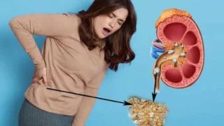 Home Remedies for Kidney Stones: 10 Natural Ways to Support Relief