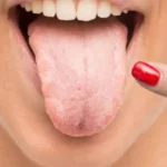 Home Remedies for Oral Thrush: 10 Ways to Soothe Symptoms Naturally