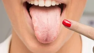 Home Remedies for Oral Thrush: 10 Ways to Soothe Symptoms Naturally