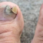 Home Remedies for Toenail Fungus: 10 Ways to Support Healthy Nails