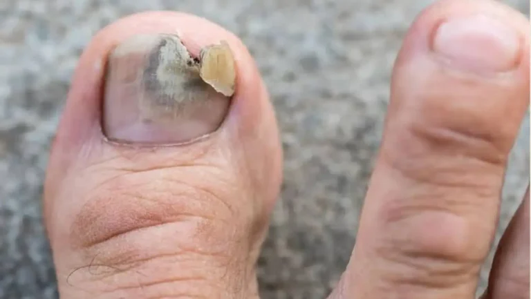 Home Remedies for Toenail Fungus: 10 Ways to Support Healthy Nails
