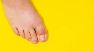 Home Remedies for Swollen Feet