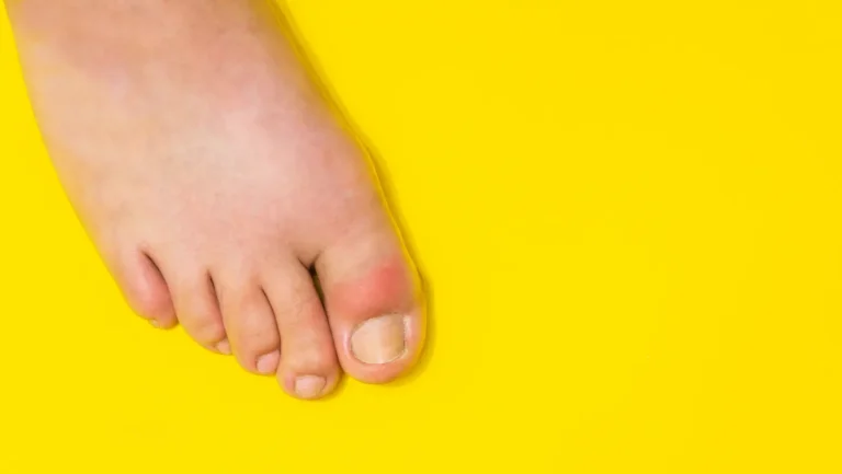 Home Remedies for Swollen Feet: 10 Ways to Reduce Swelling Naturally
