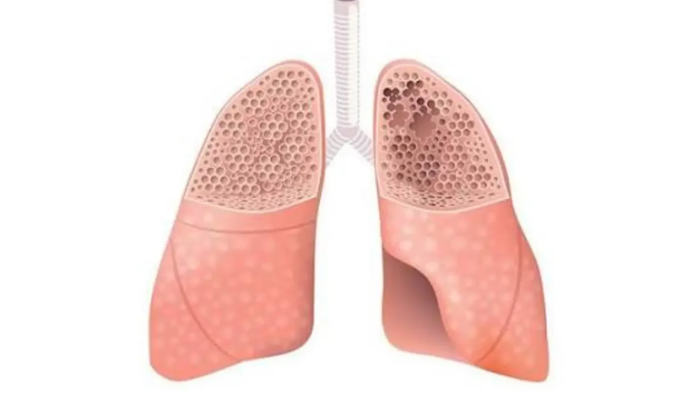 Difference Between COPD and Emphysema: Understanding the Relationship