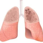 Difference Between COPD and Emphysema: Understanding the Relationship