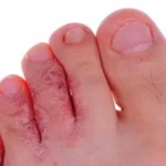 Home Remedies for Athlete’s Foot: 10 Ways to Relieve Itching & Support Healing