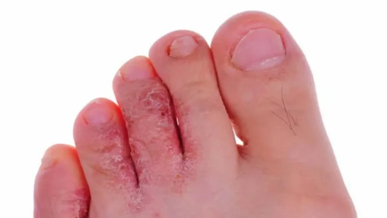 Home Remedies for Athlete’s Foot: 10 Ways to Relieve Itching & Support Healing
