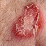 Home Remedies for Ringworm: 10 Ways to Soothe Symptoms & Support Healing