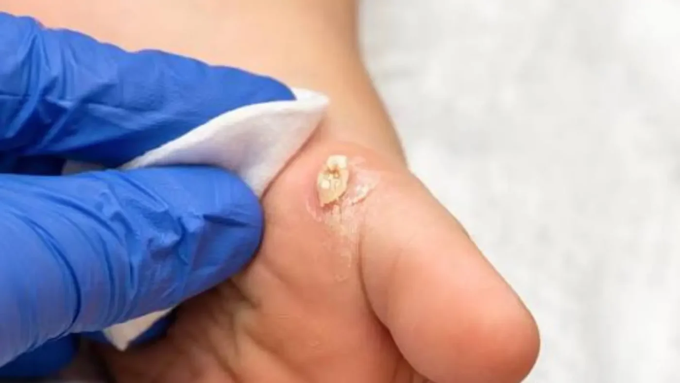 Home Remedies for Warts: 10 Ways to Support Wart Removal Naturally