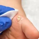 Home Remedies for Warts: 10 Ways to Support Wart Removal Naturally