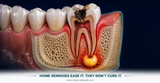 Home Remedies for a Tooth Abscess: 10 Ways to Relieve Pain